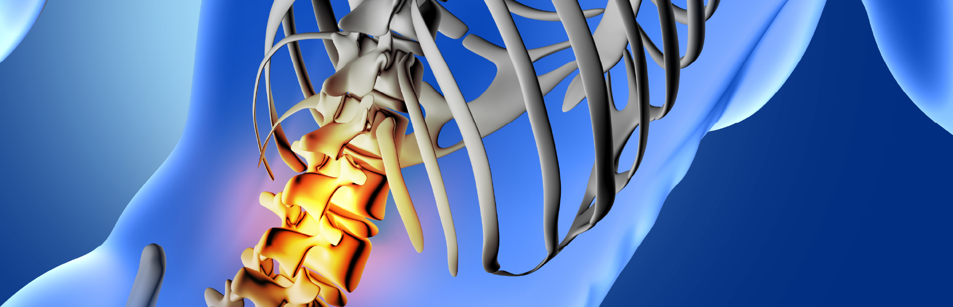 Imagen ilustrada de cuerpo humano boca abajo, se ve la columna y las costillas, se resalta con un color la parte lumbar de la columna indicando una lesión en esa zona