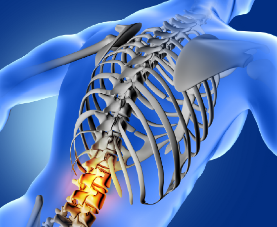 Imagen ilustrada de cuerpo humano boca abajo, se ve la columna y las costillas, se resalta con un color la parte lumbar de la columna indicando una lesión en esa zona